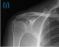 Tendinitis Calcificada Supraespinoso