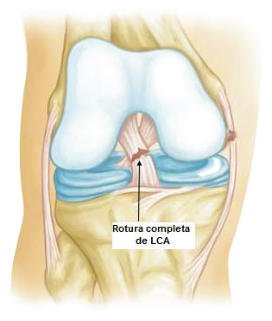 Rotura Ligamento Cruzado Anterior