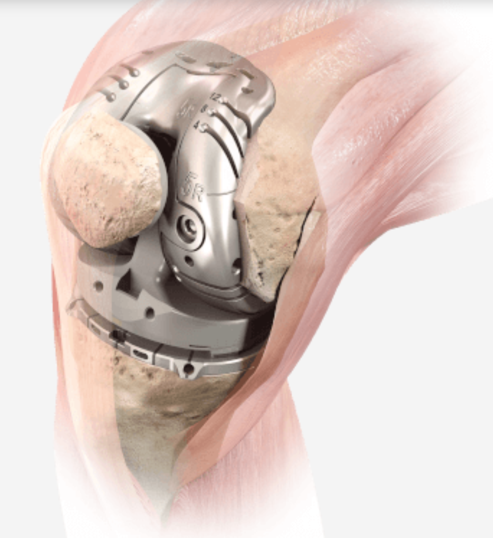 Prótesis de Rodilla implantada